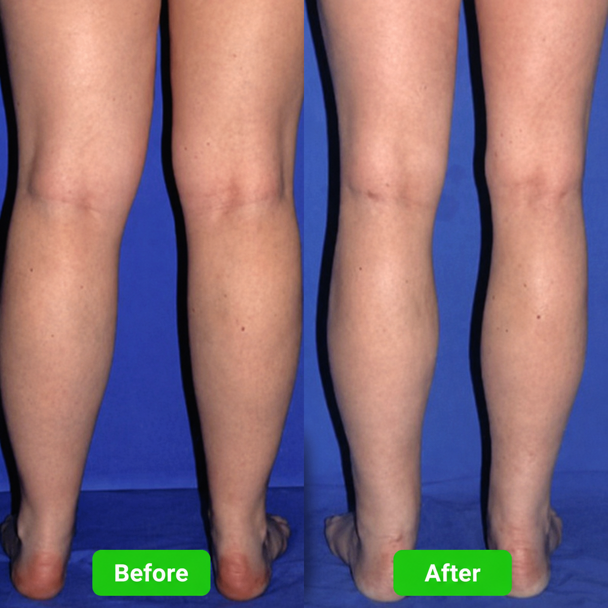 Lymphatic Drainage